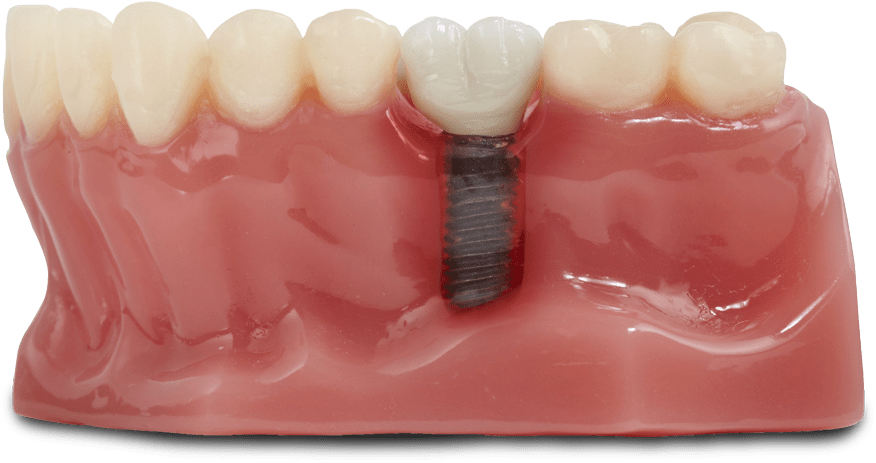 failing dental implant model Annandale, VA