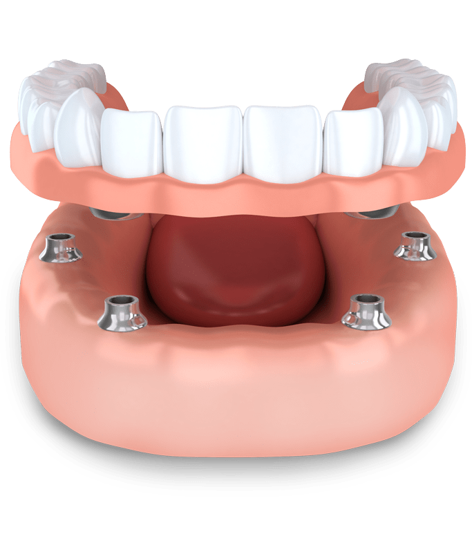 implant supported dentures model Annandale, VA