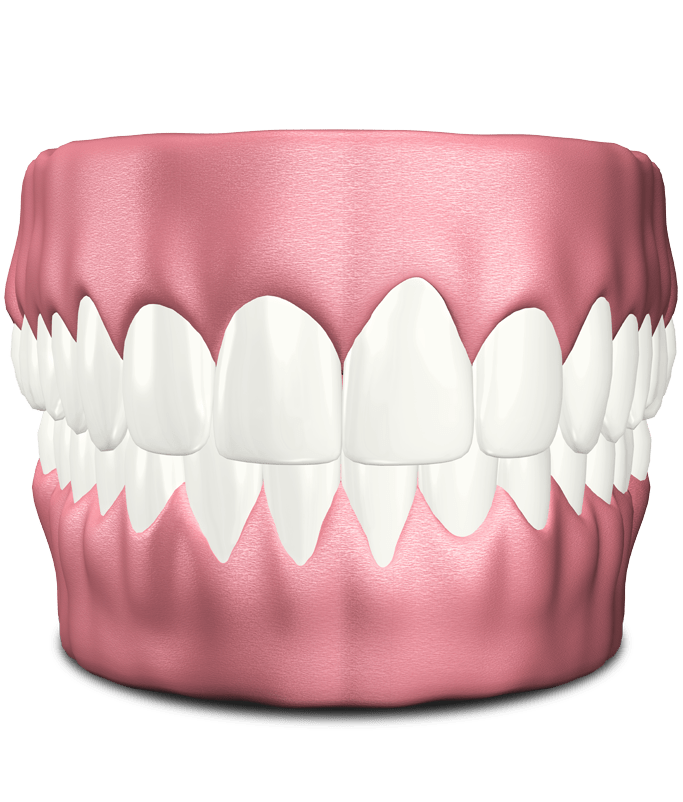 teeth model with gum recession Annandale, VA